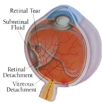 Descolamento de Retina - Instituto de Moléstias Oculares