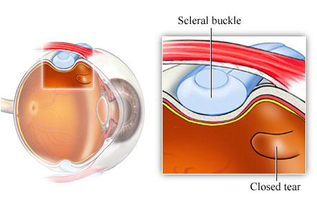 Descolamento de Retina - Instituto de Moléstias Oculares